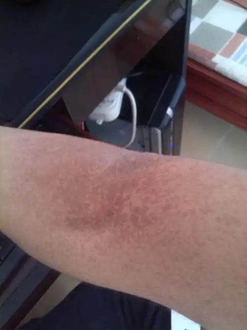 这是皮肤色素沉着吗