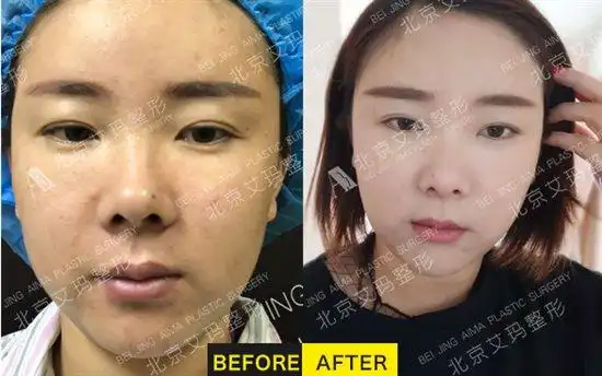 童颜针注射后出现红肿该怎么取出 丁小邦博士