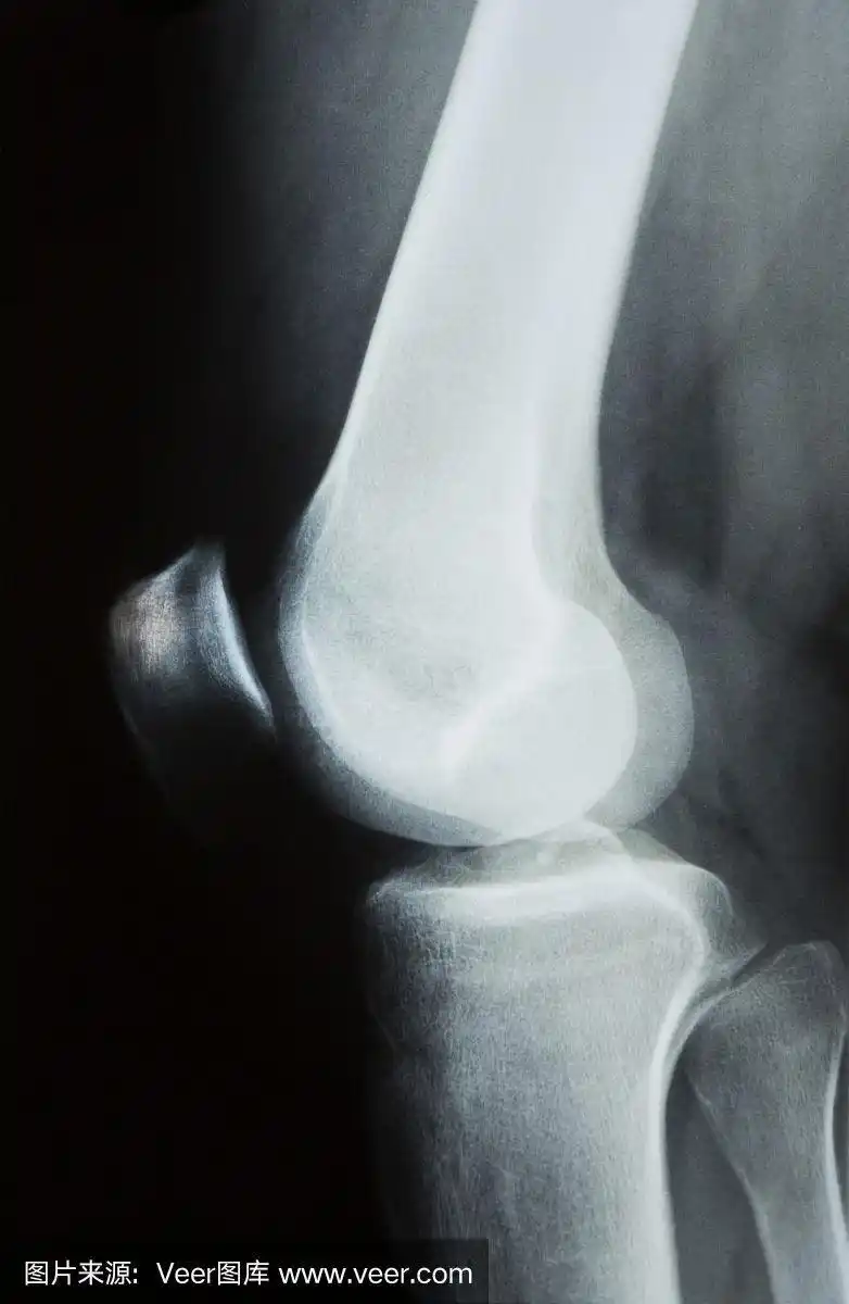 人类膝盖的x光照片