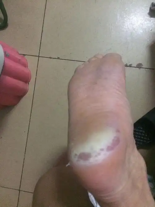 火烧一样,感觉里面释放热量出来,这个是怎么回事,夏天要是穿鞋子脚底