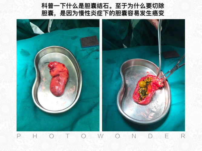 胆囊结石长什么样子?为什么要切除胆囊?