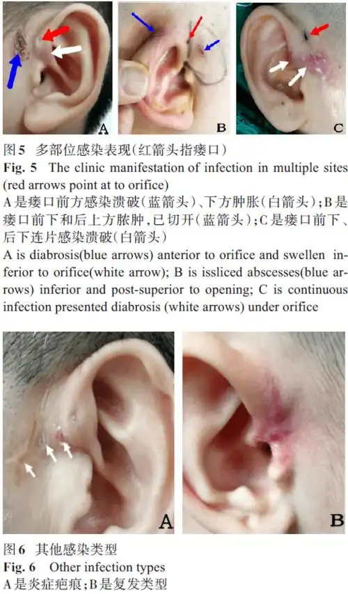 感染耳前瘘管的临床特征和手术治疗