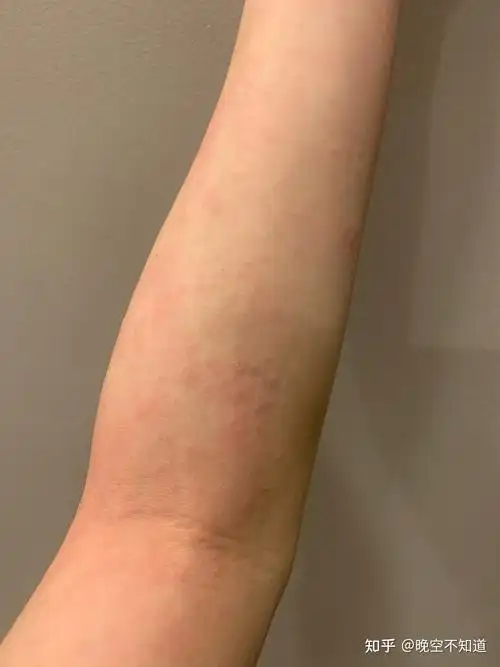 全身过敏发痒怎么办 皮肤过敏10种症状图片