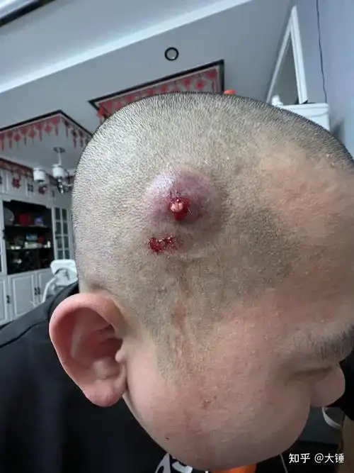 人体的火疖子 (化脓性毛囊及毛囊深部周围组织的感染) 能有多大?