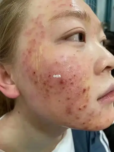 痘痘修复效果对比._痘痘_美妆_护肤