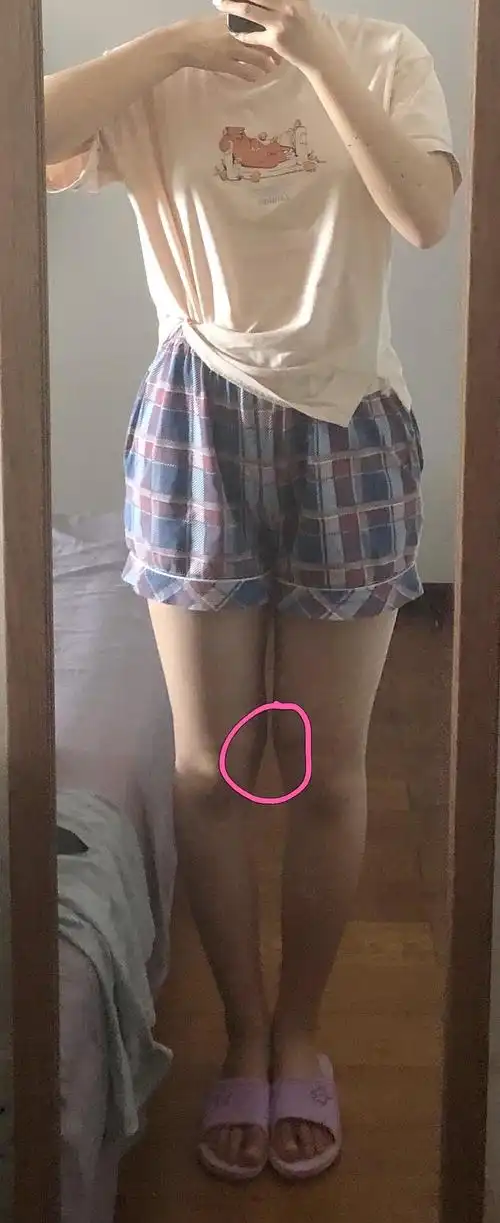 第一次发帖好紧张 我168 118斤  不知道为什么膝盖旁边那里特别突出