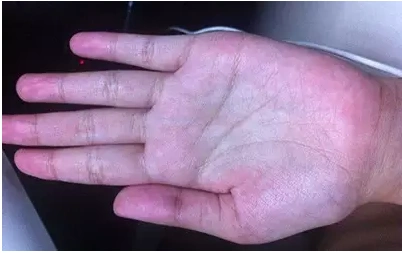 放松后又立即恢复原状,且长期存在,有的患者在脚底也可见有此种现象