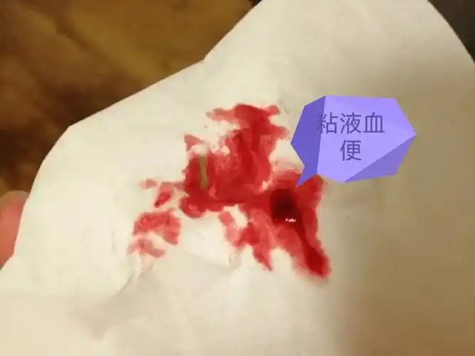 除痢疾是急性起病,其余都呈慢性病程,溃疡性结肠炎多见于青年,缺血