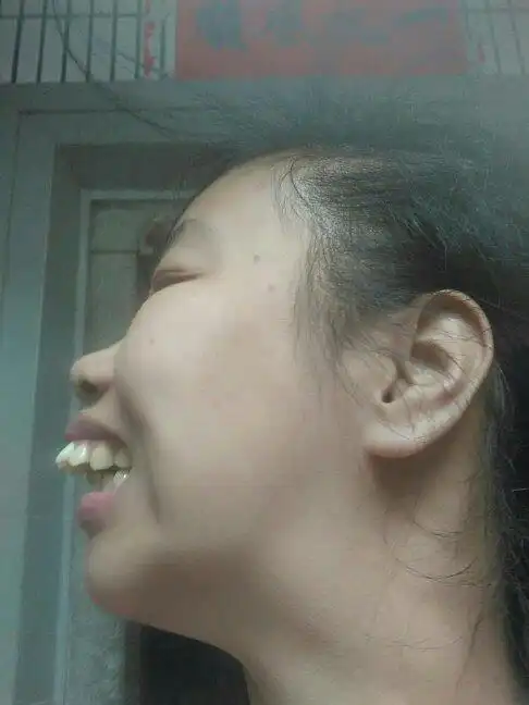 大龅牙龅出来还能矫正吗