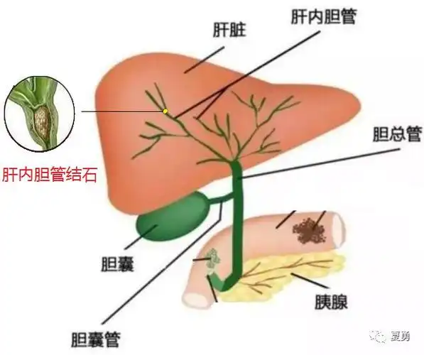 什么是肝内胆管癌