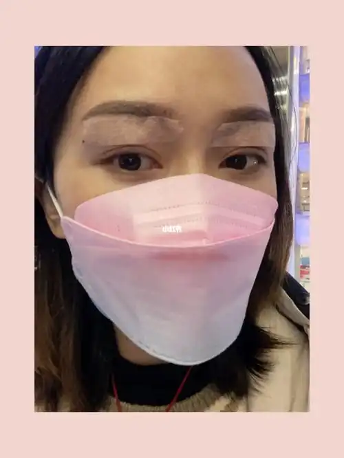 眼窝天生凹陷填充第一天