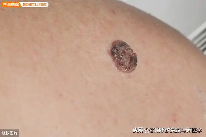 如果身上有出现这种痣,一定要注意,大多数皮肤癌都来自于它(图2)