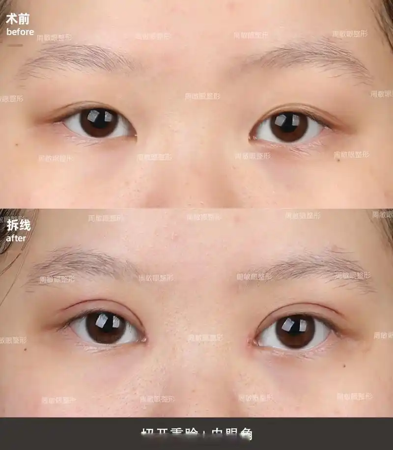 【全切双眼皮案例】双眼皮窄改宽 小美女术前双眼皮稍窄,皮肤松,脂肪