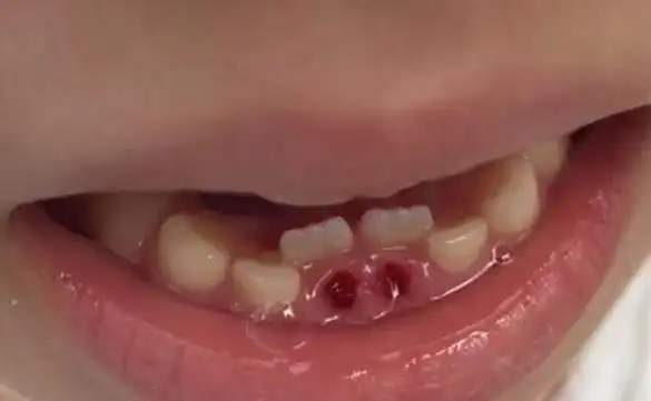 级里其他的孩子都长出了恒牙,只有吉吉没有.