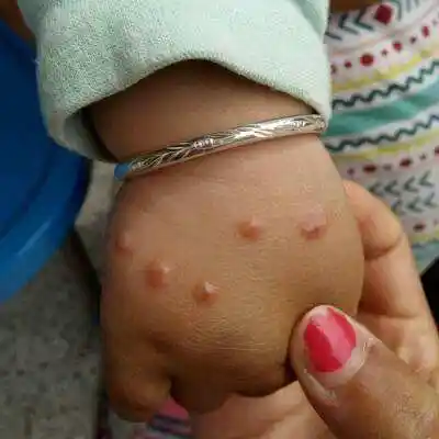 1岁宝宝身上长水泡,无知宝妈接下来这举动,差点要了孩子命!