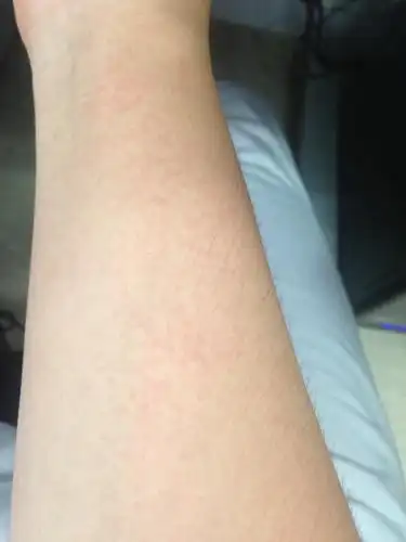 今天早上起来,发现胳膊上一片小红点,右臂内侧,不痛不痒,是过敏了吗?