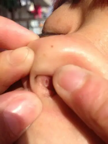 鼻子里面破了个伤口