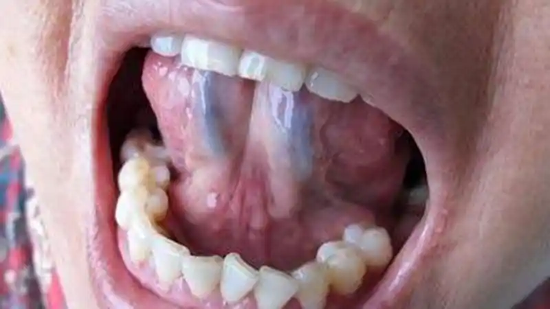 各位小伙伴,你们舌头下面又是长什么样呢?