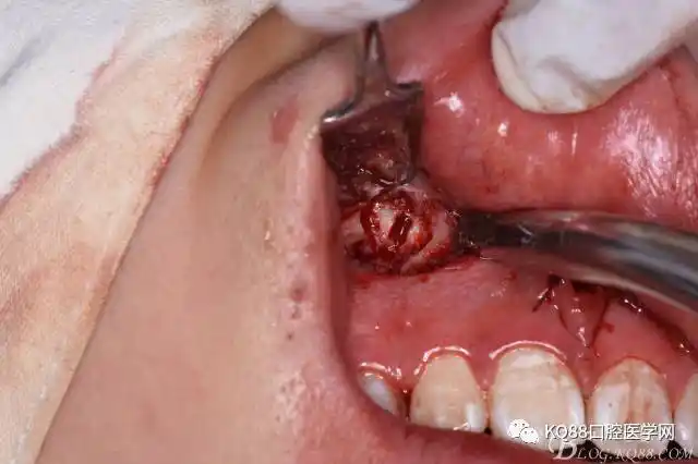 前牙区埋伏多生牙的微创拔除