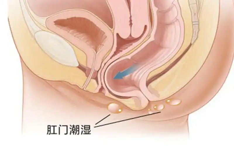 肛门湿疹