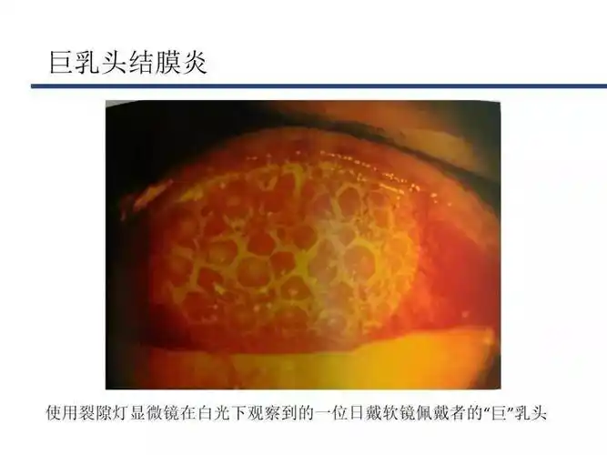 巨乳头结膜炎可发生于任何类型的接触镜,但主要见于戴软性接触镜患者.