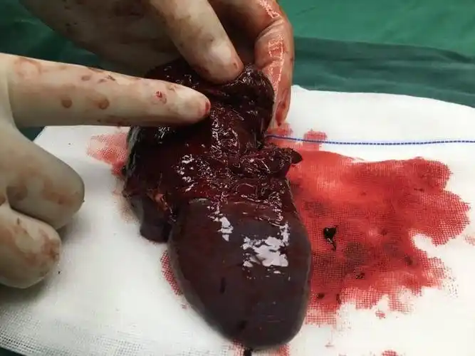 受伤破裂的脾脏(图片暴力,观文后如有不适请谅解).