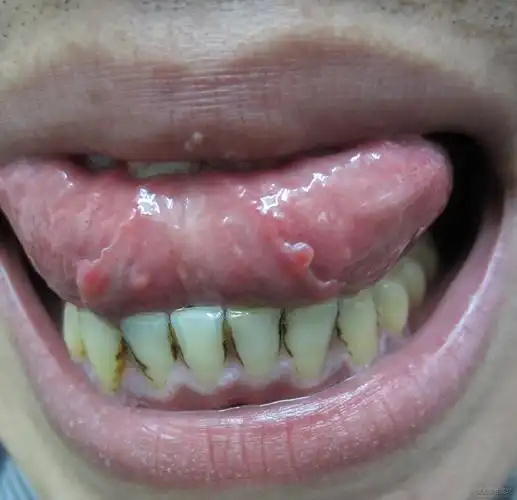 谁治疗过此病,舌系带息肉?