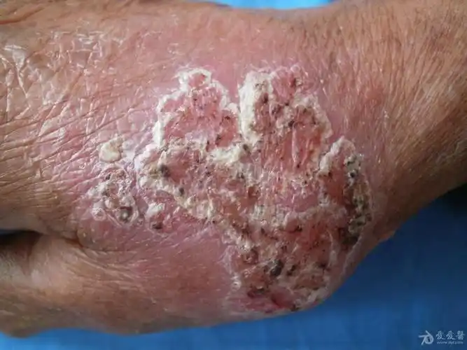 孢子丝菌病-2 - 皮肤及性传播疾病讨论版 - 爱爱医医学论坛