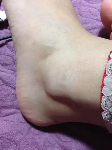 太可怕了,我突然发现左右脚踝处对称的肿起个包,其