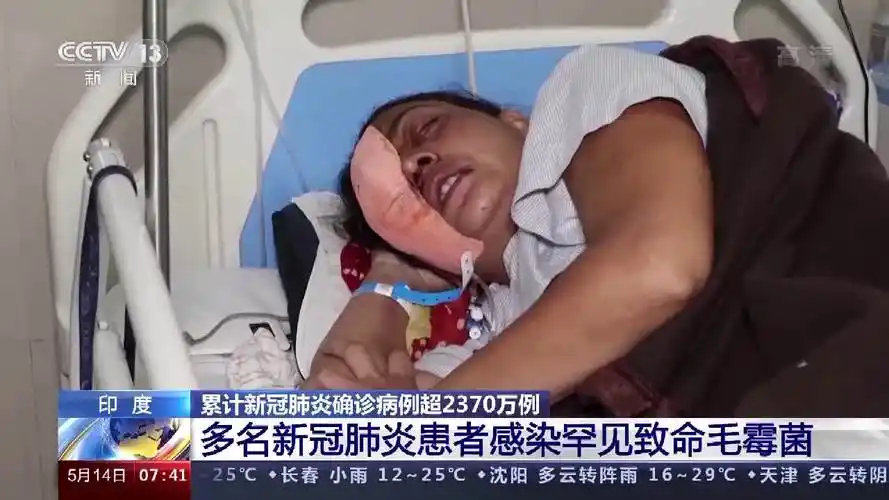 印度疫情雪上加霜患者惊现可怕毛霉菌感染