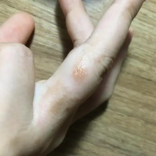 慎入,求助,手指上长了类似汗疱疹的东西,咋整啊.