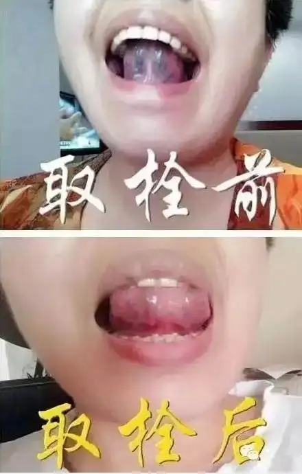 瘀 青 紫黑就要取栓排毒了(副本) 写美篇张氏祖传中医 1:无痛舌下取栓